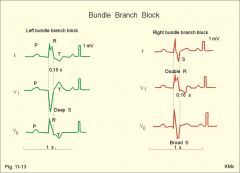ST-elevation:
- ≥1mm in 2+ limb leads
- ≥2mm in 2+ chest leads

new onset BBB (Remember: WiLLiaM & MaRRoW)