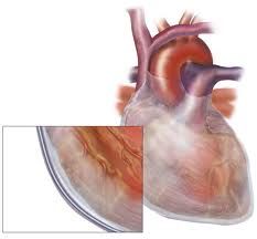 central chest pain- worse inspiration/ lying flat
relief SITTING FORWARDS!
pericardial friction rub

(pericardial effusion/ tamponade)