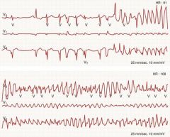 TRIGGERED activity
sustained train of depolarisations in phase 3 mytocyte AP
↑QRS/ polymorphic VT on ECG