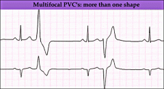 early ventricular contraction 
followed by pause...then a forceful contraction ("palpitation")