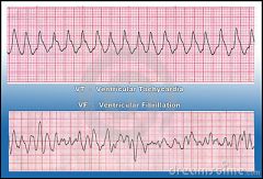 assess rhythm - ECG
DEFIB shockable rhythm (VT/VF)
ADRENALINE