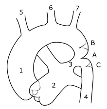 distal to the left subclavian branch. 
biscuspid aortic valve --> aortic stenosis (AS)
(may have patent ductus arteriosus)

ACYANOTIC