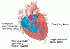 valves fail to open- remain closed 
usually an ASD or VSD shunts blood into left heart/ aorta

CYANOTIC