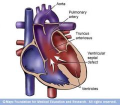 aorta & po trunk openings fused to one, VSD
CYANOTIC