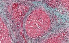 PATH: fibrosis, scarring
MECH: immune & non-immunes
Rx: minimise drug toxicity, HTN & hyper lipidaemia