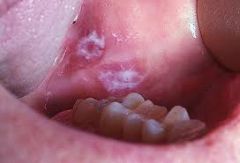 mucous membrane disorder characterised by white patches