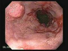 squamous PAPILLOMA (wart-like growth)---HPV
