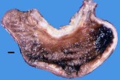 1) INTESTINAL- exterior, gland formation, better prognosis

2) DIFFUSE (pic) - stomach wall, thickening & fibrosis, worse prognosis
- linitis plastica, sclerosis, SIGNENT RING type