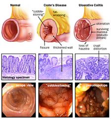 CHRON's: "skip" lesions, deep fissuring ulcers, "cobblestone", strictures

UC: continuous, severe mucosal ulceration, pseudopolyps, MUCUS