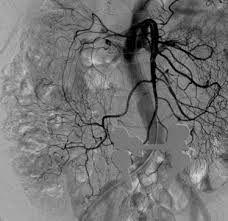 ★angiography★
colonoscopy 

INJECTION- embolisation
Endoscopic ABLATION
SURGICAL resection