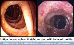 ischaemic colitis....'mesenteric angina'
- splenic flexure & rectum (points of less blood supply)