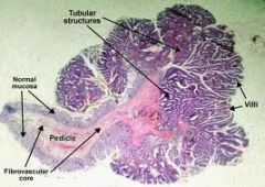 ADENOMA (pic): tubular, villous, benign, well differentiated

ADENOCARCINOMA: variable differentiation, invasive