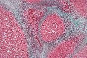 final common END-PT ....IRREVERSIBLE liver damage
fibrosis & nodular regeneration 
loss function