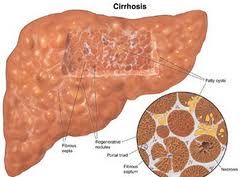 2 important complications of liver cirrhosis
- what does each complication lead to (effects)