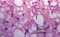 hepatocyte NECROSIS
NEUTROPHILS
MALLORY-BODIES
pericellular FIBROSIS