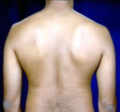 Lateral and Posterior Chest