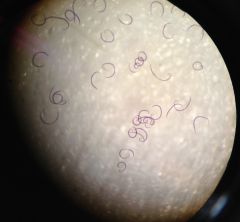 Disease caused by Trichinella spiralis
name and key features