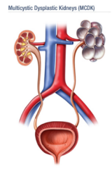 - Multiple cysts of varying sizes on one of the kidneys
- Contralateral (normal) kidney hypertrophies to compensate for lost functional kidney mass