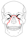 Är en pyramidformad fraktur. Fås oftast av slag mot mellersta delarna av maxillan. Involverar näsroten, laterala delar av maxillan, lacrimalbenet med dess tårkanalen och ligger nära foramen infraorbitale innehållande n. infraorbitales.