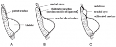 - Urachal cysts (C)
- Vesical diverticulum (B)
- Vesico-umbilical fistula (A)

- Failure of regression of the urachus and alantois