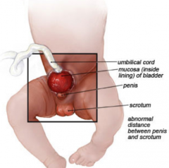 - Mucosal lining of the posterior bladder wall is exposed on the ventral abdominal wall
- Males: often associated w/ Epispadias (dorsal opening of penile urethra)
- Females: often associated w/ a shortened vagina and a bifid clitoris
- Also ass...