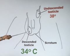 undescended testicle 
- sperm cannot be made at room temp. so testes descend to the scrotum where the temp is around 34 degrees 