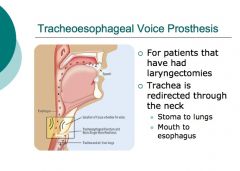 Tracheoesophageal prosthesis.

electrolarynx and esophageal speech are alternatives
esophageal speech is difficult to learn. 
Use of an electrical devise is considered too mechanical sounding by many pt's/