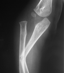 A 12-year-old male sustains an ulnar fracture with an associated posterior-lateral radial head dislocation. After undergoing closed reduction, the radiocapitellar joint is noted to remain non-concentric. What is the most likely finding?  
1.  Lat...