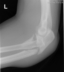 In pediatric Monteggia fractures the annular ligament is commonly interposed in the radiocapitellar joint.  The most common injury pattern is an extension type 1 with anterior radial head dislocation and apex anterior ulnar shaft fracture. The ape...