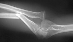 A 45-year-old male falls off his motorcycle and injures his arm. AP and lateral radiographs reveal an ulnar shaft fracture, 30 degrees apex anterior, and a radial head dislocation. Which direction is the radial head most likely dislocated? 
1.  L...