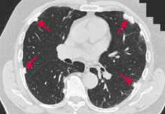 Asbestosis:
- Associated with increased risk of bronchogenic carcinoma and mesothelioma
