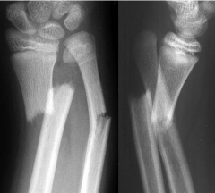 1-galeazzi=distal radial shaft with disruption of the distal radioulnar joint (DRUJ) GRIMUS
-joint is most stable at the extremes of rotation
2-true lat=direction of displacement
3-supination
4-ECU most common interposed tendon
5-triangular f...
