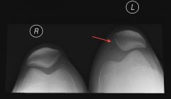 27yo fball player sustains an acute lat patellar dislctn. Which is the most likely site of injury seen on MRI?  1-Soft-tissu patellar-sided avulsion of MPF lig; 2-Soft-tissu fem-sided avulsion of MPF lig; 3-Midsub MPF lig ruptr; 4-Bony fem avulsio...