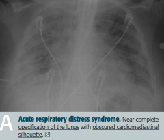 Acute Respiratory Distress Syndrome
- Near complete opacification of the lungs
- Obscured cardiomediastinal silhouette