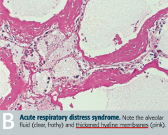 Acute Respiratory Distress Syndrome
- Alveolar fluid (clear and frothy)
- Thickened hyaline membranes (pink)