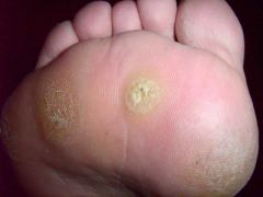 -verucca plantaris
- solitary or multiple warts found on the plantar side of the foot, can cause foot pain if located on pressure areas (e.g. metatarsal head, heel)
- appearance: flesh-colored with rough, hyperkeratotic surface