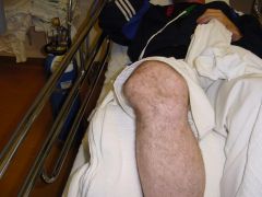 pt in the ER w/ an acute lateral patellar dislctn. Which factors is assocd w/ the highest risk of persistent patellar instability? 1-Younger age; 2-Inc Q-angle 
3-Male gender; 4-Previous patellar instability event; 5- Amount of lat patellar tilt