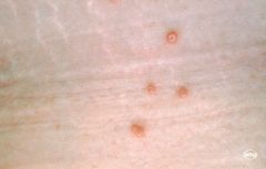 - a common, self-limited viral infection caused by a poxvirus, common in sexually active young adults and in children
- it manifests as small papules (2-5 mm) with CENTRAL UMBILICATION. Lesions are asymptomatic. In HIV-positive patients, lesions ...