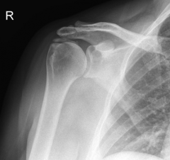 pt has shoulder pain & dysfunction. xray Fig A. If this pt undergoes shoulder arthroscopy, which structure is  abnormal? 1-supraspinatus; 2-infraspinatus; 3-subacromial bursa; 4-superior labrum; 5.  biceps tendon (long head)