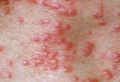 - causes by the human skin mite sarcoptes scabiei var hominis
- highly contagious- transmitted via skin-to-skin contact or through towels, bed linens, or clothes
- pathogenesis- the mites tunnel into the epidermia, lay eggs, and deposit feces (c...