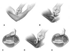 What is the most appropriate initial management of a suspected distal biceps rupture with a tendon that can be palpated but is painful during the hook test examination?
1.  Operative exploration of distal biceps tendon
2.  Immobilization for thr...