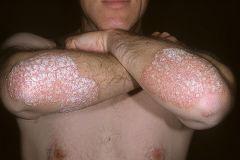 Clinical features of psoriasis