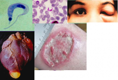 -can transmit thru TRANSFUSIONS
-central Am and brazil
-reduviid bug = kissing beetle
-can cross placenta and cause dz prenatally
-find in tissue scraping or blood smear (c shaped trypomastigote)
-dx by letting uninfected bugs feed on pxt, la...