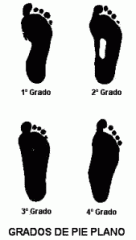 Pregunta:

¿En el pie plano valgolaxo el eje longitudinal del astrágalo y el escafoides forman tanto en el plano lateral como el dorsoplantar un ángulo de?