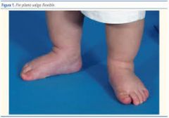 Pregunta:

¿Cuáles son las causas del pie planovalgo contracturado?