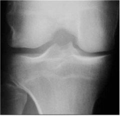 Matching the size of the donor knee to the size of the recipient knee is crucial for successful meniscus transplantation, include axial malalignment, ACL insufficiency,  (+) sign DJD changes femoral condylar flattening (fairbanks changes). Grade I...