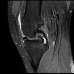 A "double PCL sign" seen on a sagittal MRI image of a knee is indicative of which of the following conditions? 1-Skeletal immaturity; 2-ACL tear; 3-PCL injury; 4-Combo ACL &PCL tear; 5-Bucket-handle meniscal tear