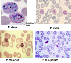 -lots of eos (CBC) and ring forms on smear
-gametocytes - sexual **** know this
-picked up by mosquitos
-gametocytes - schiz - troph - ring forms
-look for ring forms****
***-vivax (more this) and ovale = schuffner dots (stippling prod by bod...