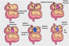 week 4-5
septum primum develops 
ostium primum (hole down by endocardial cushion), closes
ostium secundum forms in upper septum primum
septum secundum forms with foramen ovale **
septum primum becomes thin flap over FO