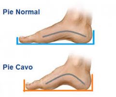 Exploración del pie cavo.

- En el pie cavo  el grado de movimiento en la  
  articulación  del tobillo no esta limitado.
- La amplitud de movimientos en la articulación subastragalina por regla general  esta limitada.